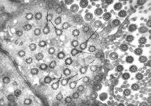 F,5y. | immotile cilia syndrome - trachea F,5y. | immotile cilia syndrome - trachea